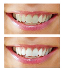cosmetic-teeth-whitening (1)